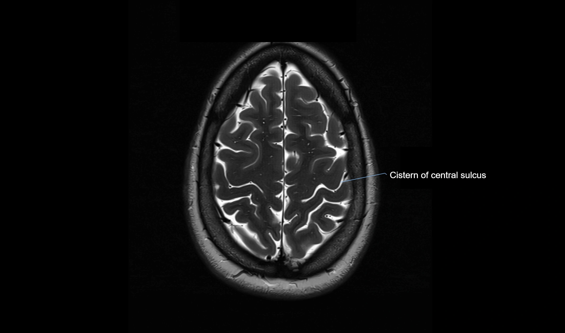 Brain cisterns  and ventricles  axial anatomy 3T MRI image-img-00001-00049.webp